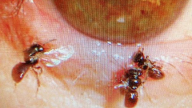 sweat bees living within woman's eye